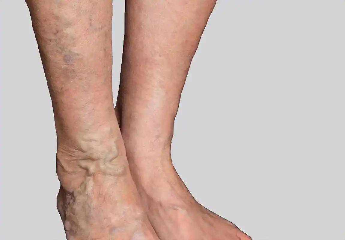 开云体育入口-女子因肺栓塞不幸走了!医生:天冷宁愿躺一天,也别干这5事!