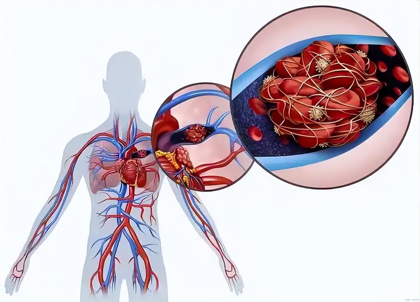开云体育入口-女子因肺栓塞不幸走了!医生:天冷宁愿躺一天,也别干这5事!